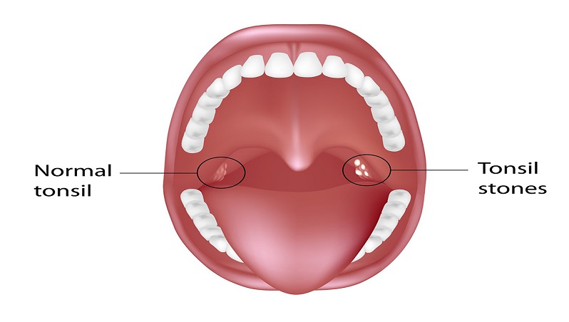 Bademcik Ameliyatı Bademcik Ameliyatı