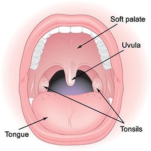 Tonsillectomy