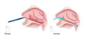Burun Eti Konka Ameliyatı Öncesi Sonrası