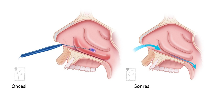 Nasal Concha Surgery 