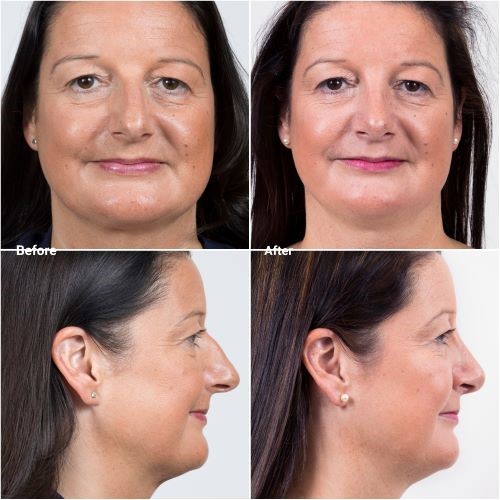 After piezo rhinoplasty