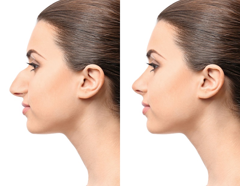Young woman before and after rhinoplasty on white background. Pl
