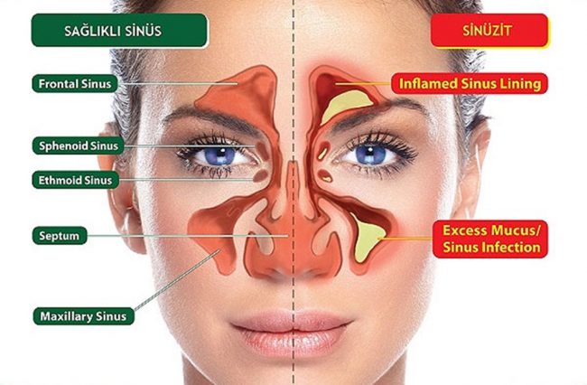 Sinüs Enfeksiyonu (Sinüzit)