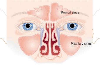 Sinus Infection (Sinusitis)