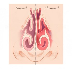 Türbinatlar: normal ve anormal karşılaştırma