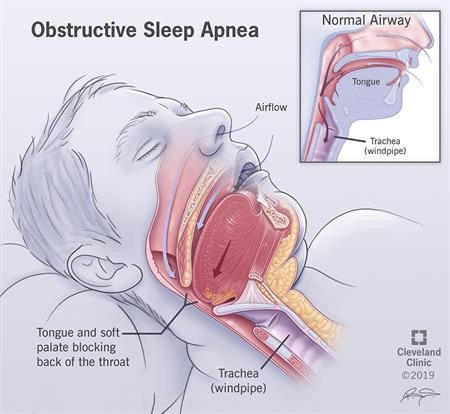 Sleep apnea