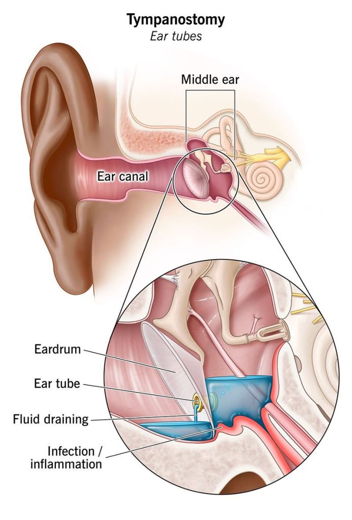 Tympanostomy