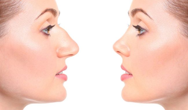 Rhinoplasty Surgery Prices in Turkey Rhinoplasty Surgery Prices in Turkey