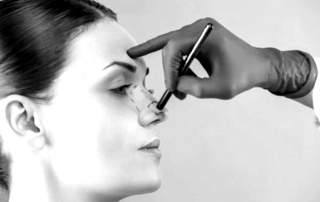 Burun Estetiği Rinoplasti Hakkında Bilmek İstedikleriniz