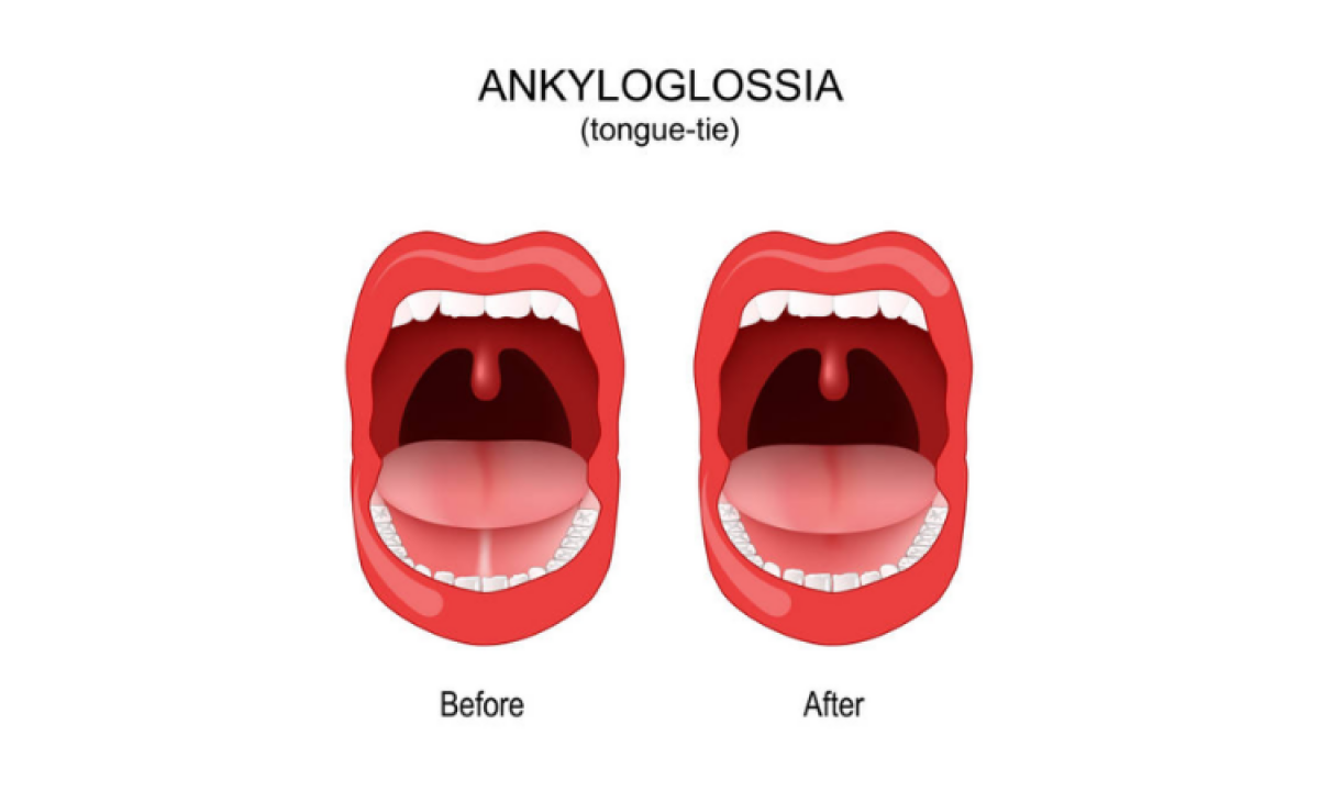 Dil Bağı - Ankyloglossia