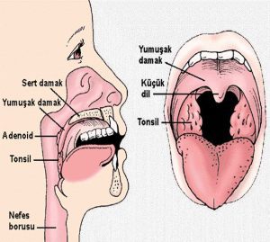 Adenoid