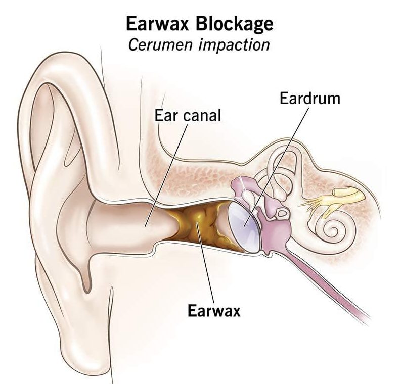 Kulak Kiri Temizliği