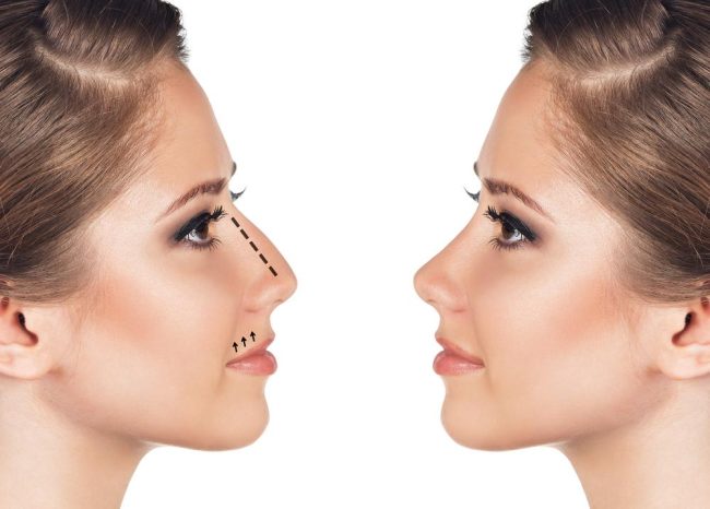 Rinoplastide dikiş alınır mı?