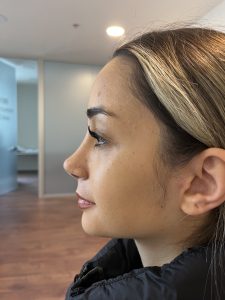 Will the nostrils enlarge after rhinoplasty? 2 Will the nostrils enlarge after rhinoplasty?