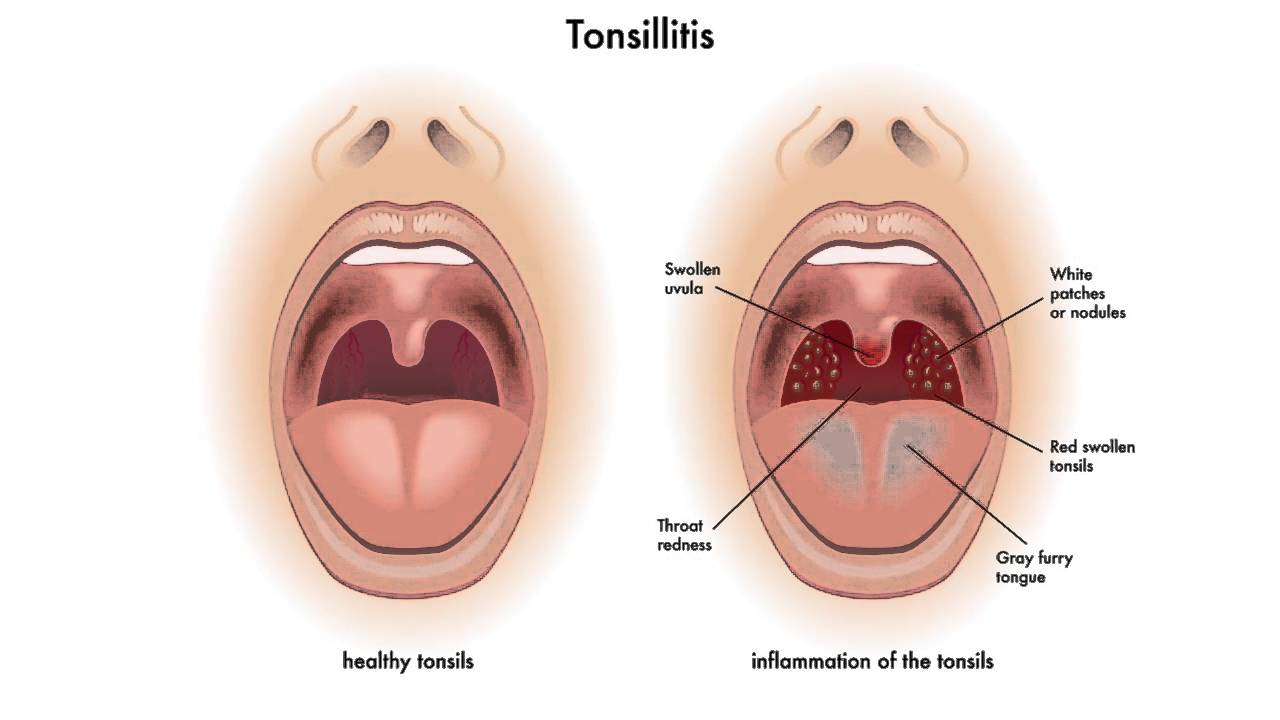 Tonsillectomy