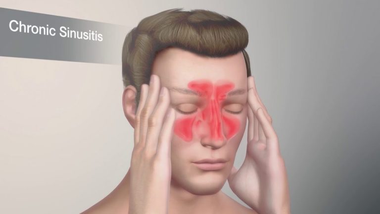 Sinusitis Symptoms