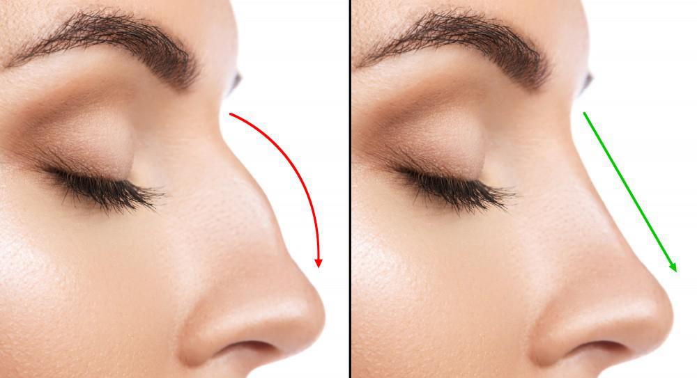 How many days should I rest after rhinoplasty?