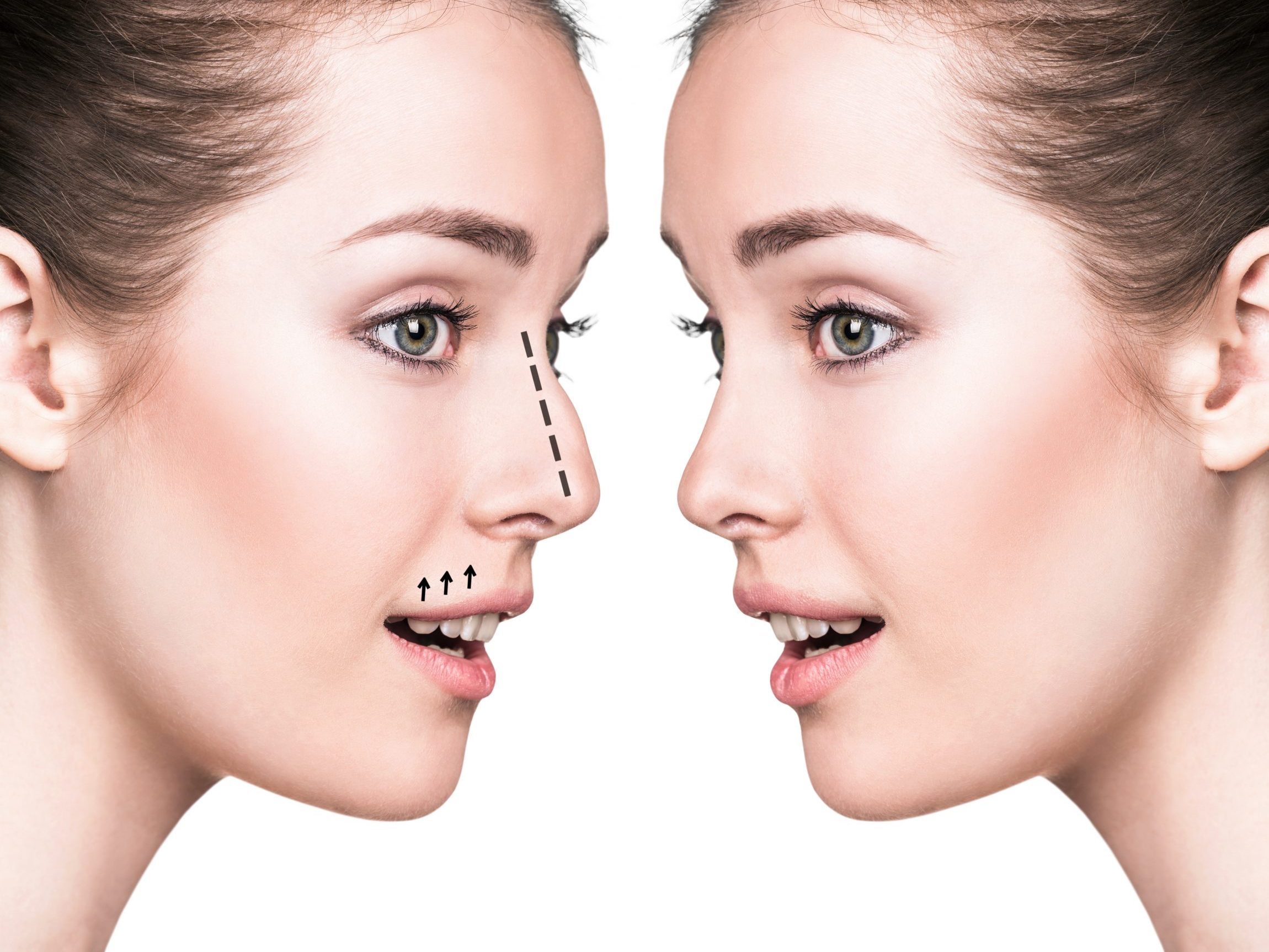 Rhinoplasty Surgery in Turkey 8 Before After Rhinoplasty Surgery