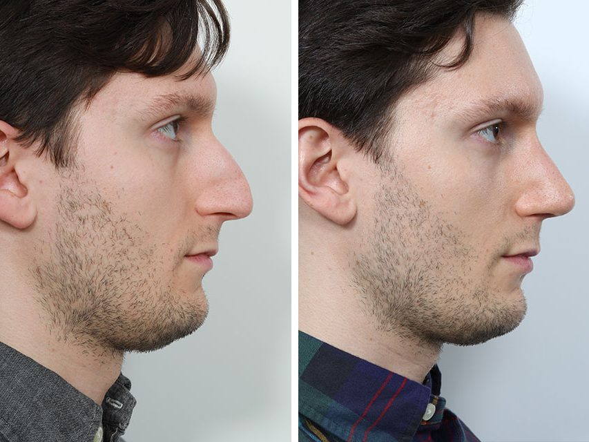 Rhinoplasty Surgery in Turkey 2 Before After Rhinoplasty Surgery
