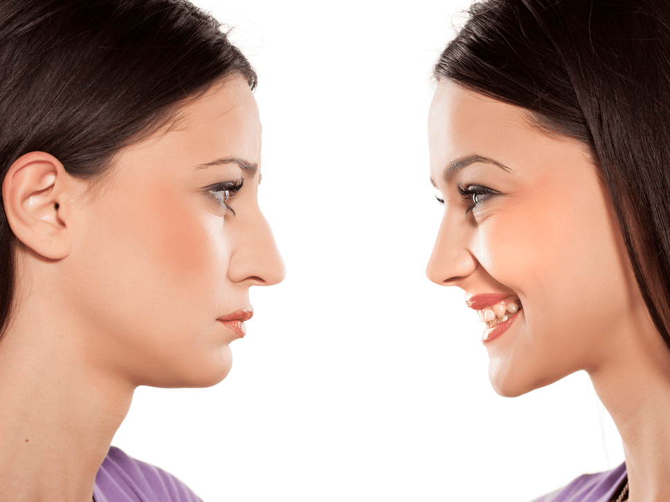 Rhinoplasty Surgery in Turkey 6 Before After Rhinoplasty Surgery