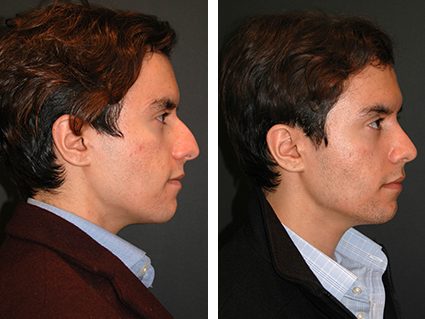 Rhinoplasty Surgery in Turkey 5 Before After Rhinoplasty Surgery