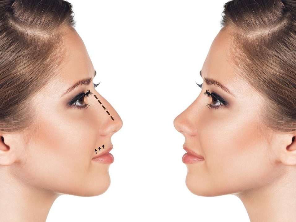 Rhinoplasty Surgery in Turkey 4 Before After Rhinoplasty Surgery