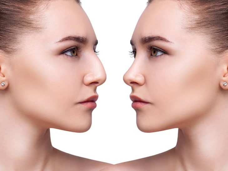 Rhinoplasty Surgery in Turkey 3 Before After Rhinoplasty Surgery