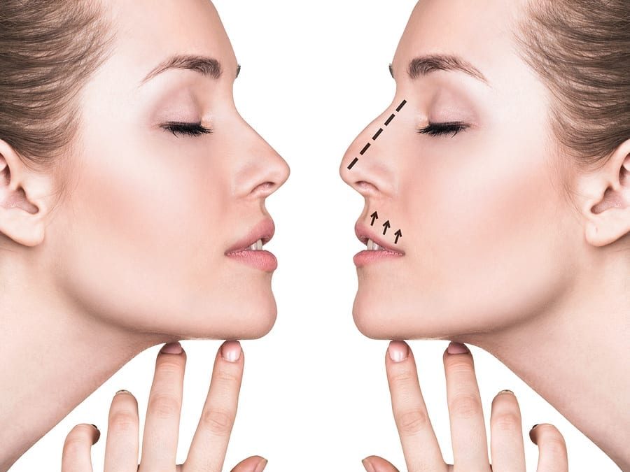 Rhinoplasty Surgery in Turkey 1 Rhinoplasty Surgery in Istanbul
