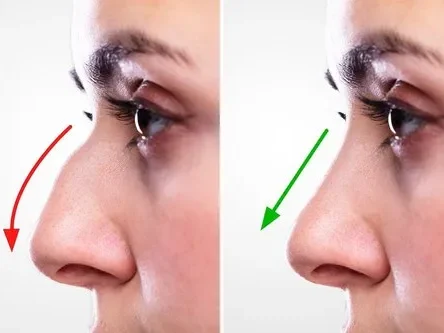 Rhinoplasty Surgery in Turkey 9 rhinoplasty nose surgery rhinoplasty surgeon bhopal 500x500 1