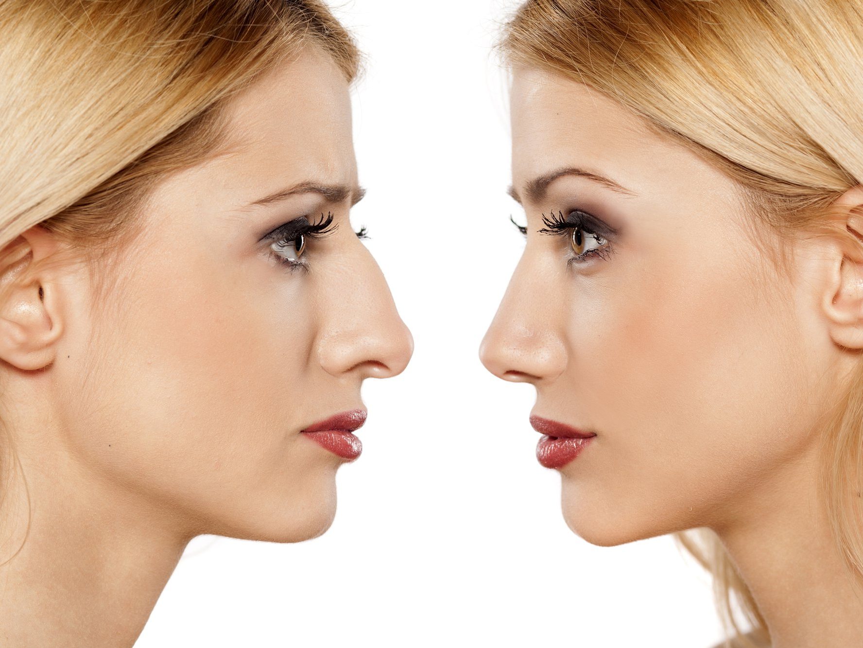 Rhinoplasty Surgery in Turkey 7 Before After Rhinoplasty Surgery