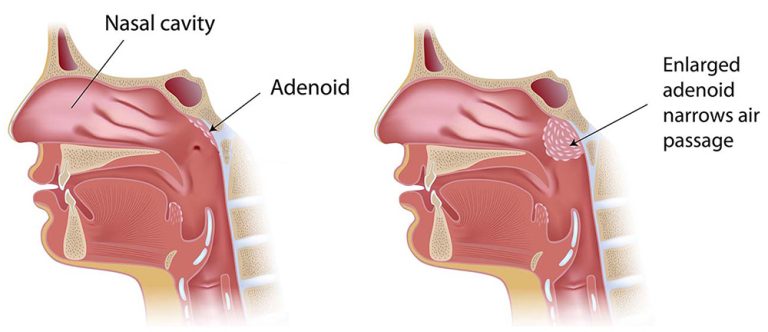 Adenoid Symptoms 2 Adenoid Symptoms